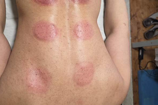 Massage Cupping1