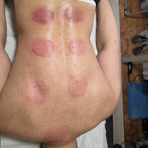 Massage Cupping2