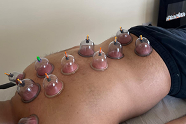 dry-cupping